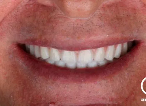 Depois do tratamento