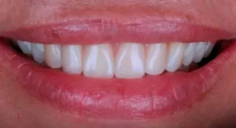 Depois do tratamento