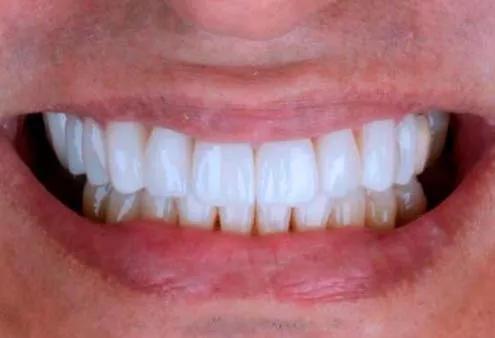 Depois do tratamento