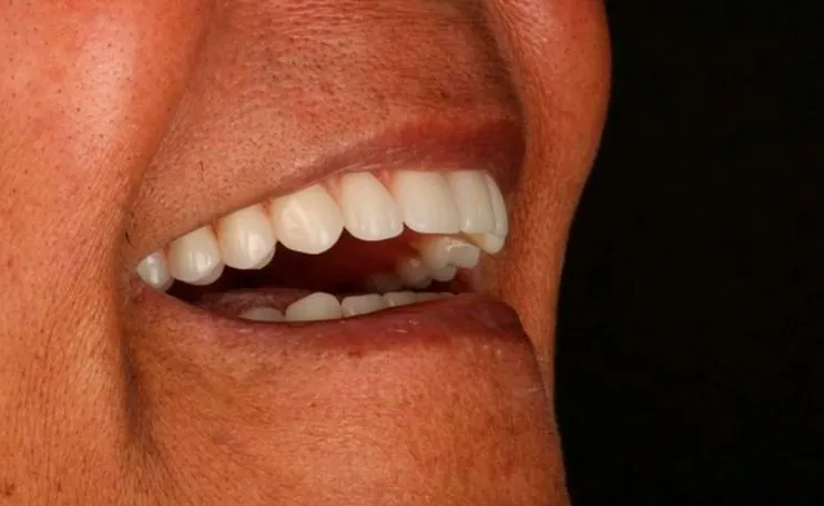 Depois do tratamento