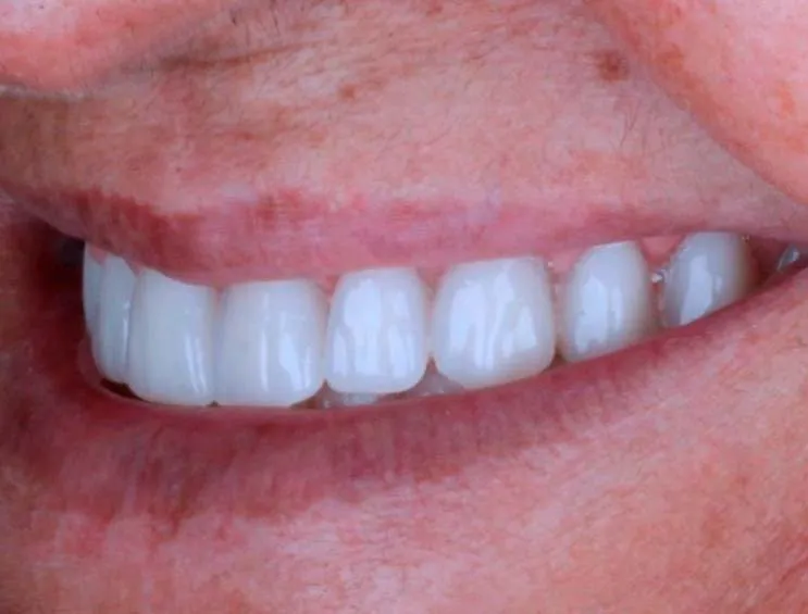 Depois do tratamento