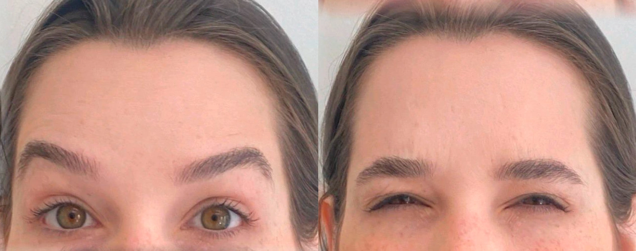 Depois do tratamento